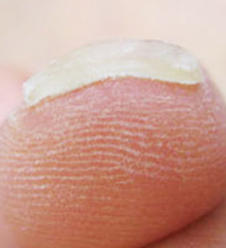 巻き爪事例アフター