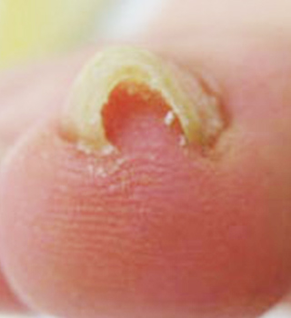 巻き爪事例ビフォー