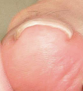 巻き爪事例アフター