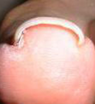 巻き爪事例ビフォー