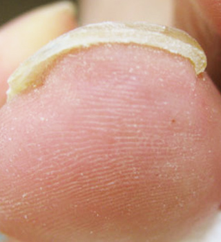 巻き爪事例アフター