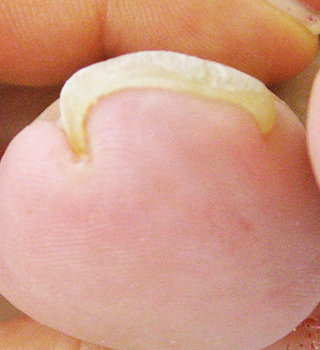 巻き爪事例ビフォー