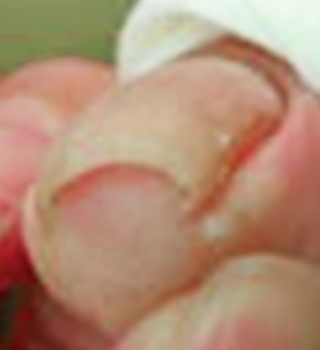 巻き爪事例ビフォー